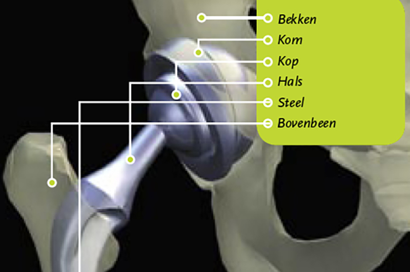 Nieuw heup