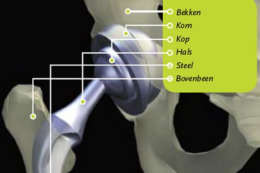 Nieuw heup